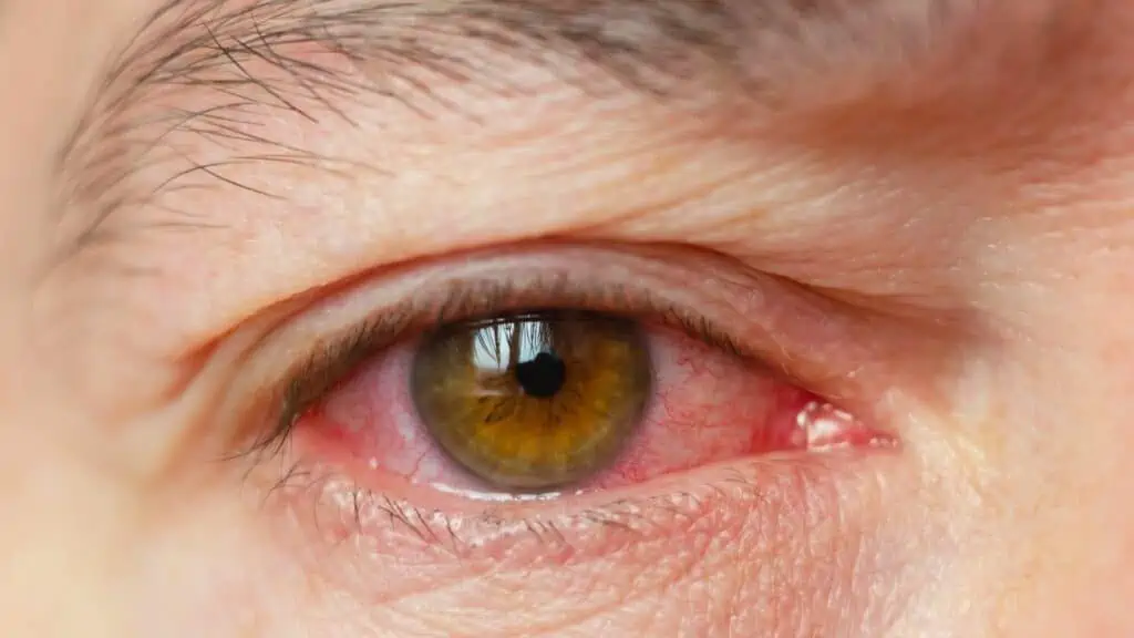 What Happens If You accidentally swam in shocked pool- red eyes